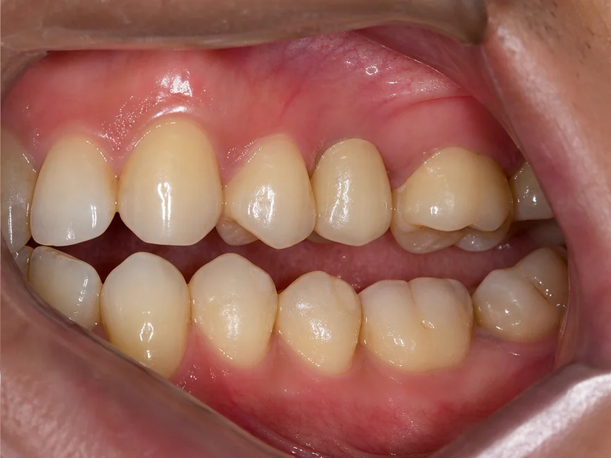 Phục hình một răng cối nhỏ hàm trên bằng mão sứ trên Implant tại Sante