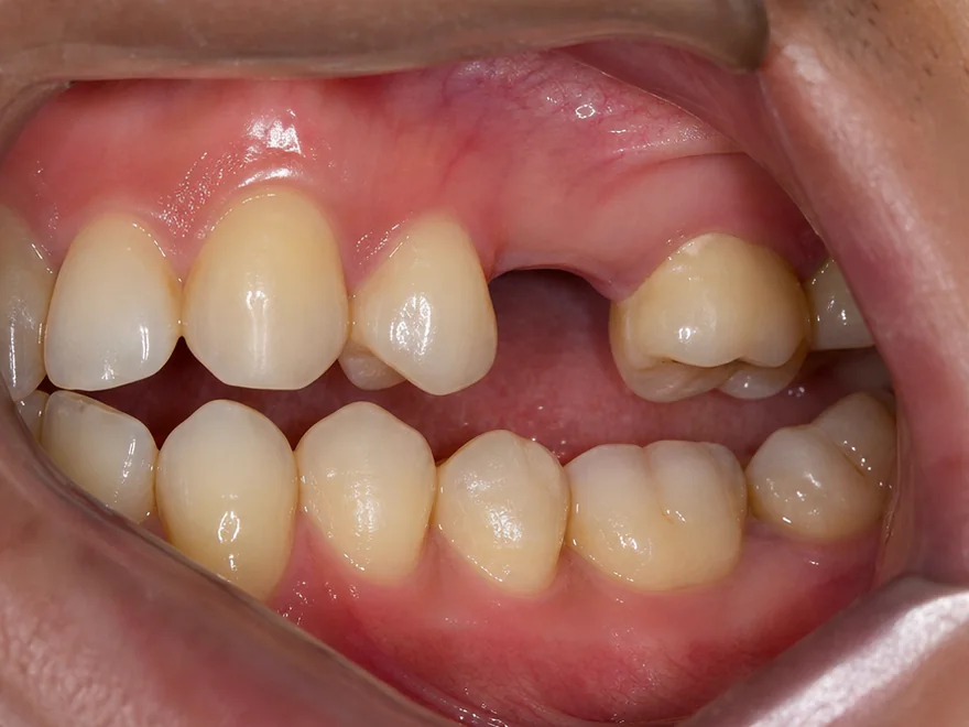 Tình trạng mất một răng cối nhỏ hàm trên trước khi cấy ghép Implant tại Sante