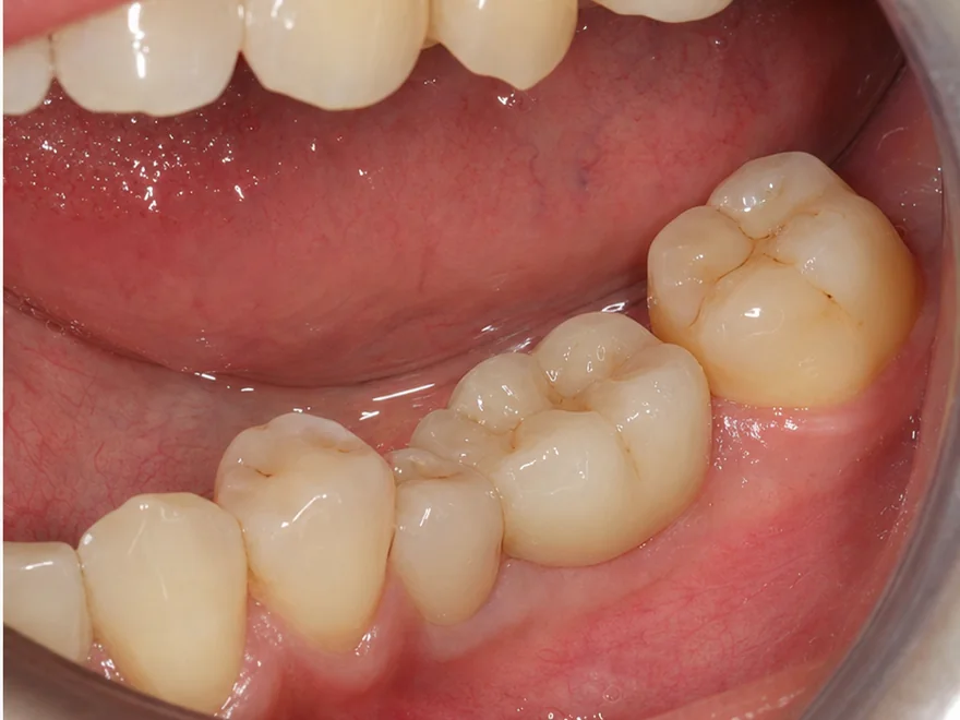Phục hình một răng hàm dưới bằng mão sứ trên Implant giúp khôi phục ăn nhai tại Sante