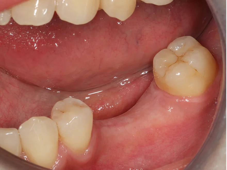 Tình trạng mất một răng hàm dưới trước khi phục hình Implant tại Nha khoa Bệnh viện Quốc tế Sante