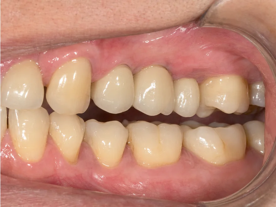 Phục hình hai răng cối nhỏ liền kề bằng hai mão sứ trên Implant riêng biệt tại Sante