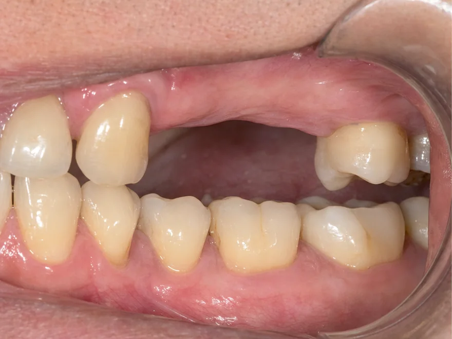 Tình trạng mất hai răng cối nhỏ liền kề hàm trên trước khi cấy ghép Implant tại Sante