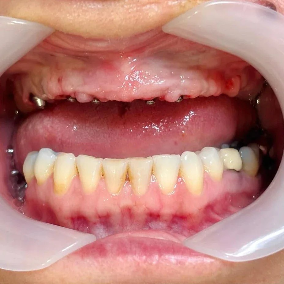 Trước điều trị: Mất răng lâu năm tụt nướu