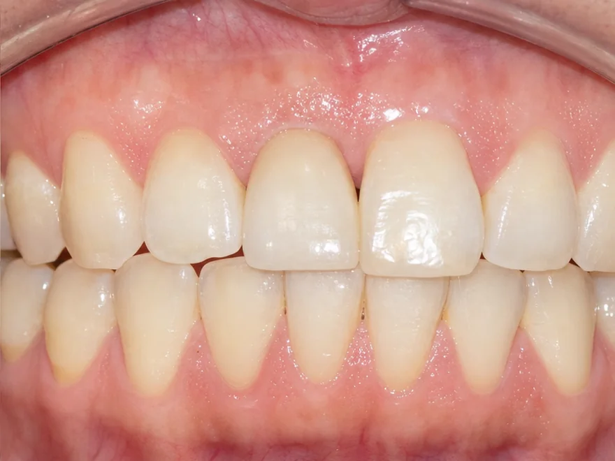 Phục hình một răng cửa bằng Implant đơn lẻ tự nhiên tại Nha khoa Bệnh viện Quốc tế Sante