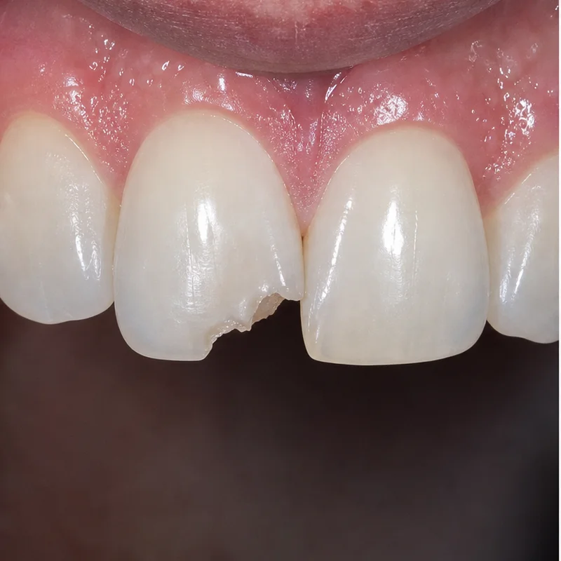 Răng cửa bị mẻ vỡ góc lớn mất thẩm mỹ
