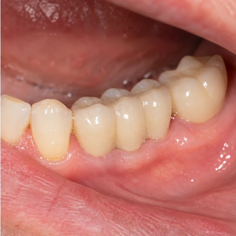 Cầu răng sứ trên Implant phục hồi ăn nhai tại Sante Hospital