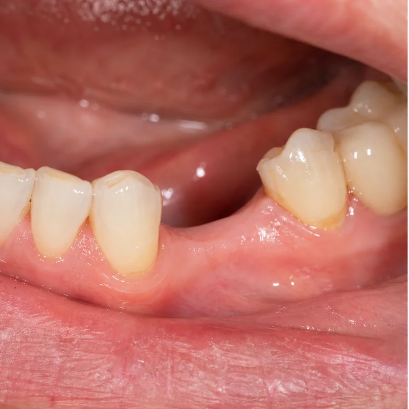Mất 3-4 răng liền kề tiêu xương nướd