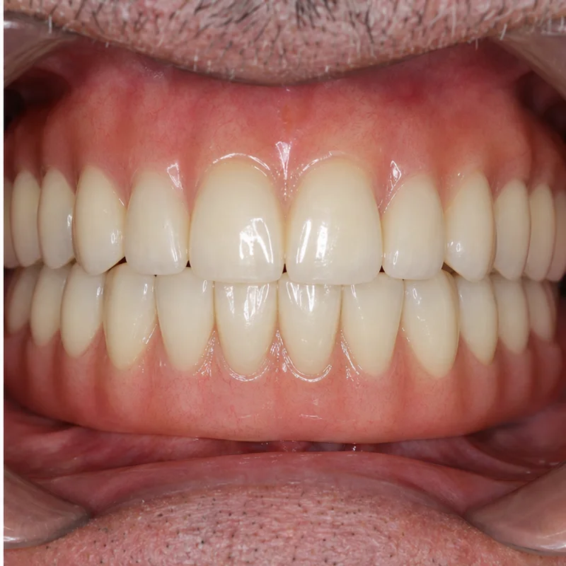 Kết quả răng sáng bóng tự nhiên duy trì bền vững tại Sante