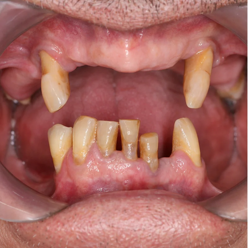 Tình trạng răng ố vàng do tuổi tác trước điều trị tại Sante