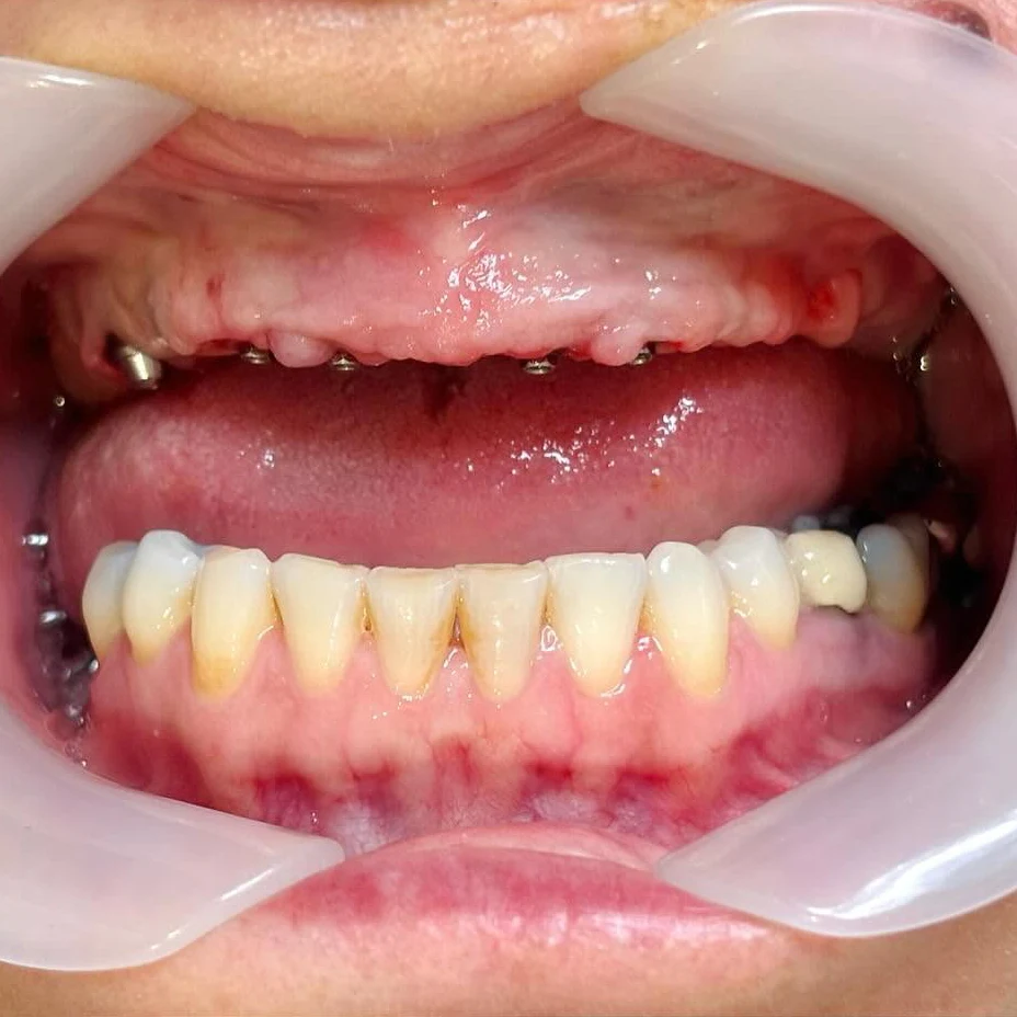 Tình trạng mất răng tiêu xương toàn hàm trước điều trị tại Sante