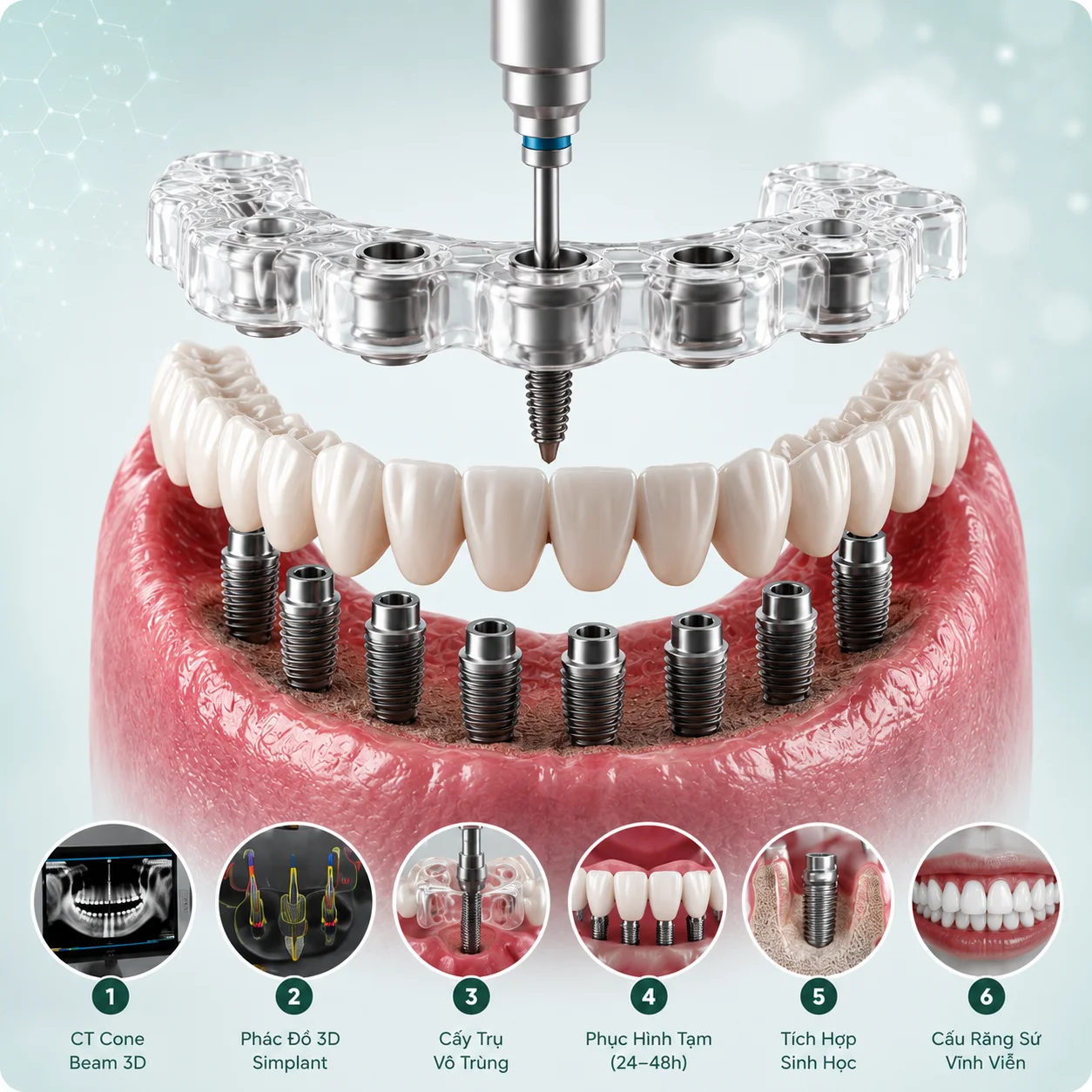 Mô hình phẫu thuật trồng răng Implant toàn hàm 3D tại Nha khoa Bệnh viện Sante